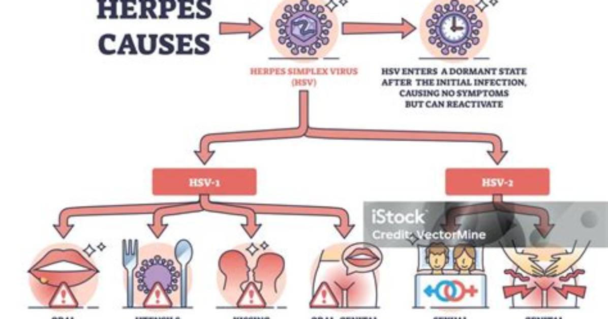Does Herpes Cause Pyuria?