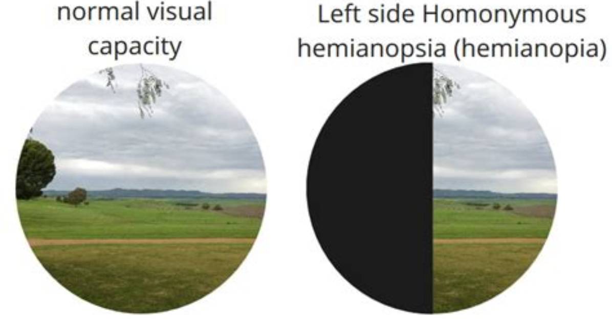 Does Homonymous Hemianopia Improve?