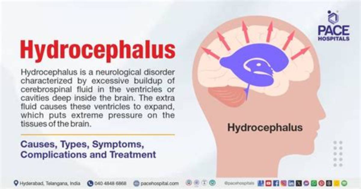 Does Hydrocephalus Cause Headaches?