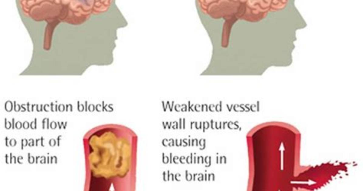 Does Hypertension Cause Ischemic Stroke?
