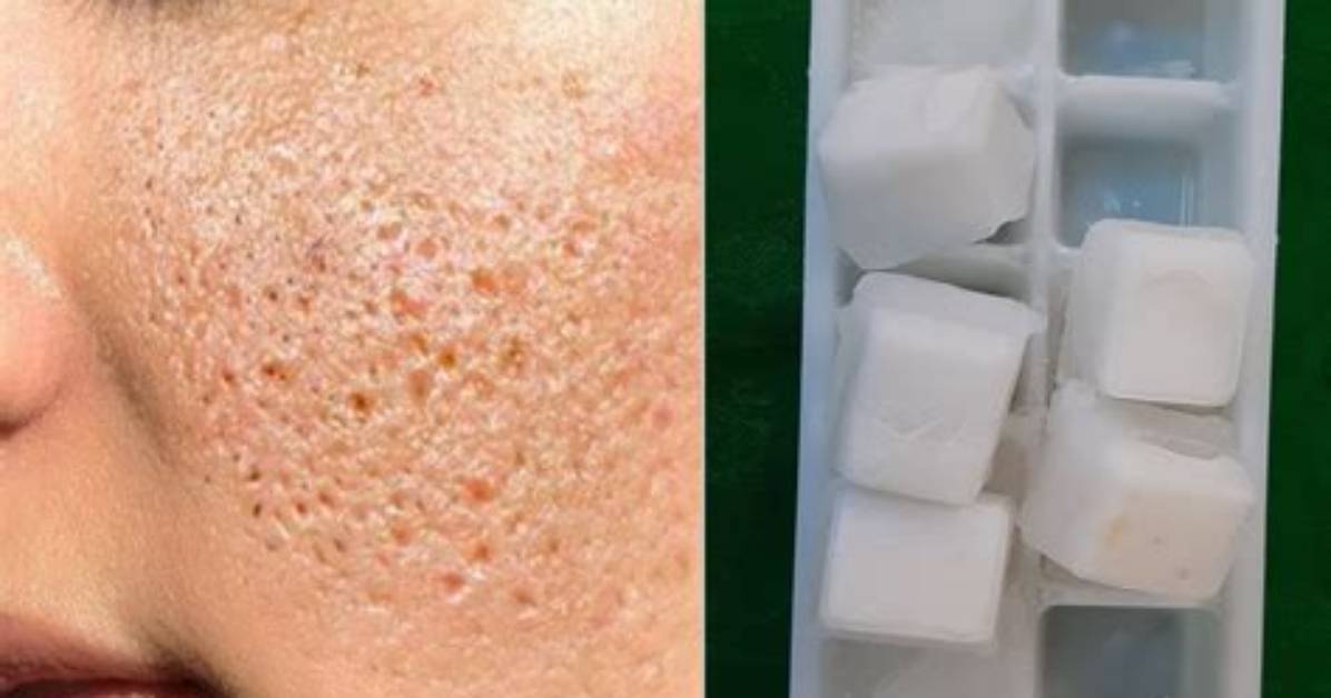 Does Ice Close Pores?