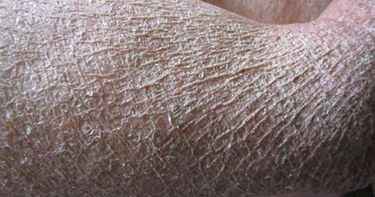 Does Ichthyosis Get Worse