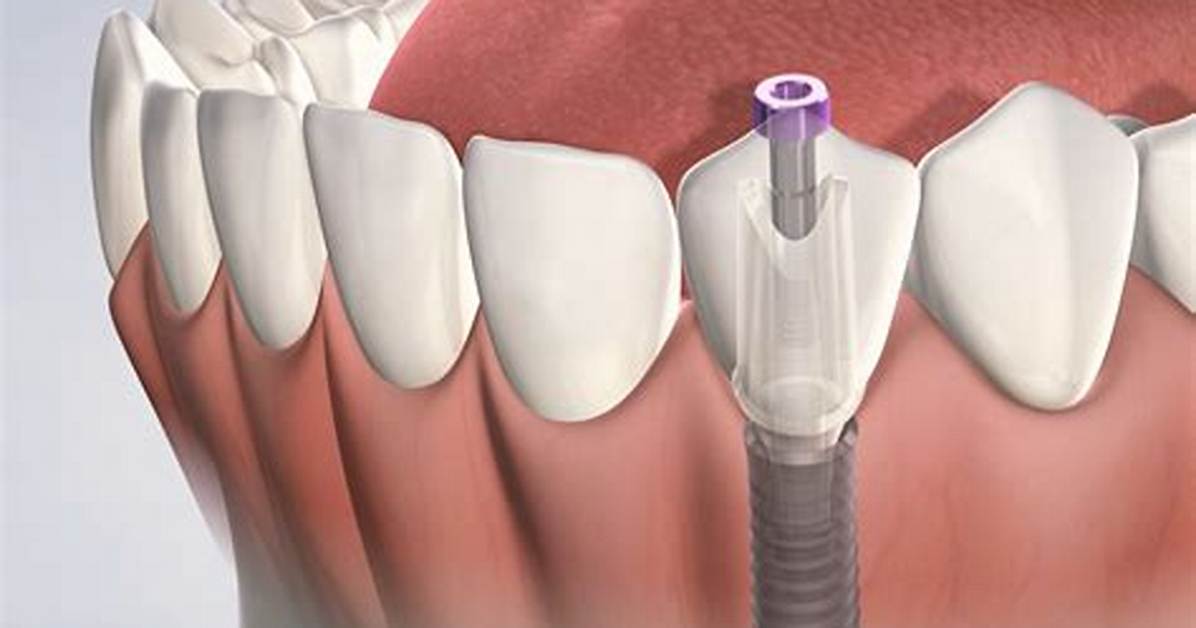 Does Implant Teeth Hurt?