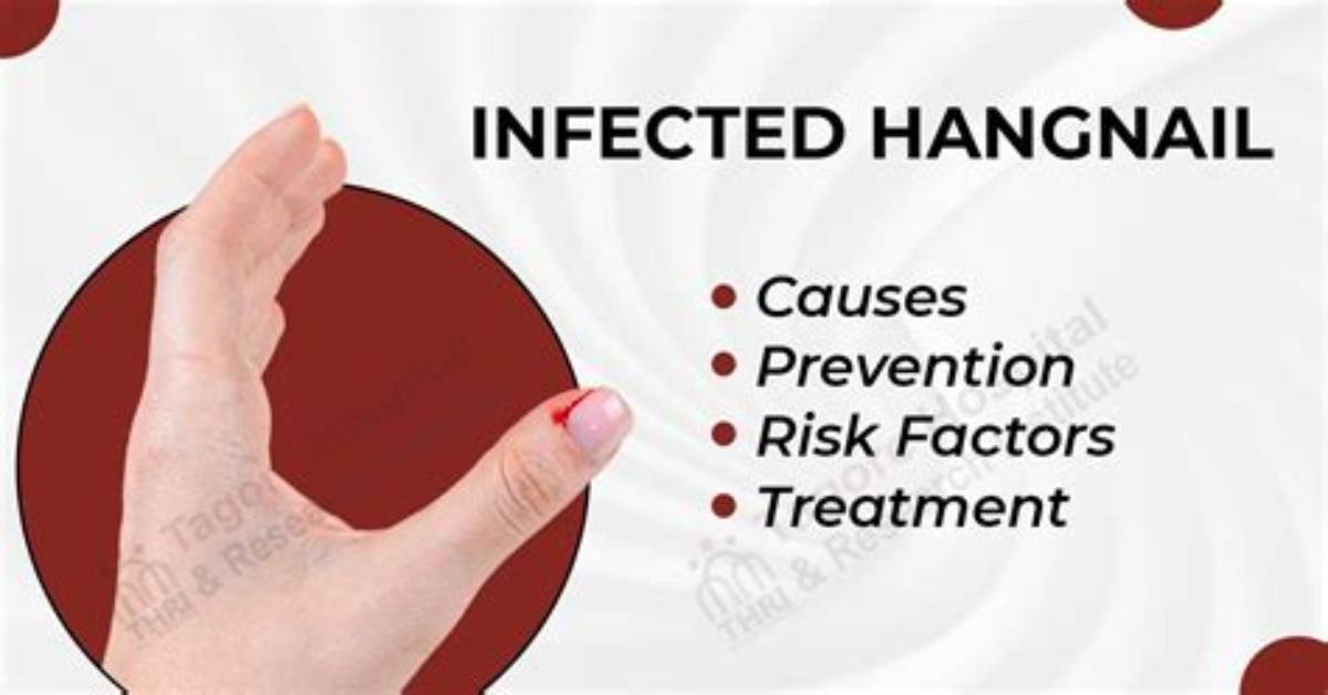 Does Infected Hangnail Go Away?