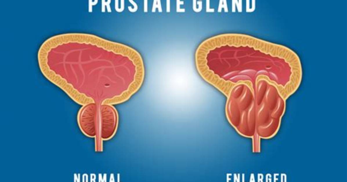 Does Inflamed Prostate Feel Like?