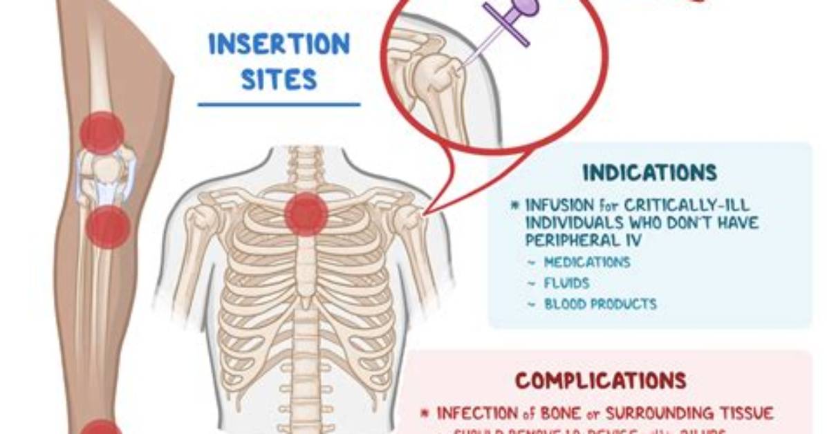 Does Intraosseous Infusion Hurt?