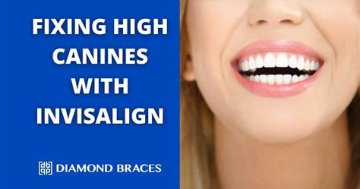 Does Invisalign Work for High Canines?
