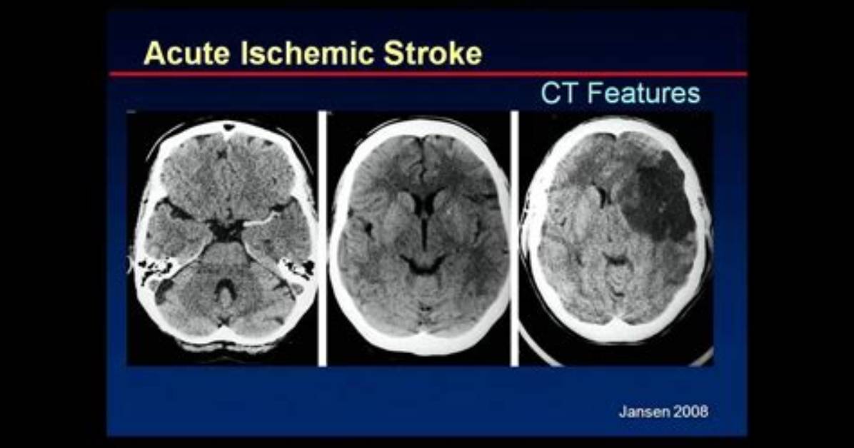 Does Ischemic Stroke Show up on Ct?