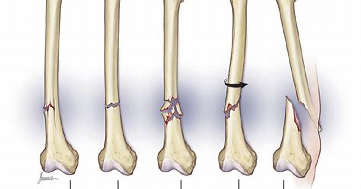 Does Itching Mean a Broken Bone Is Healing?