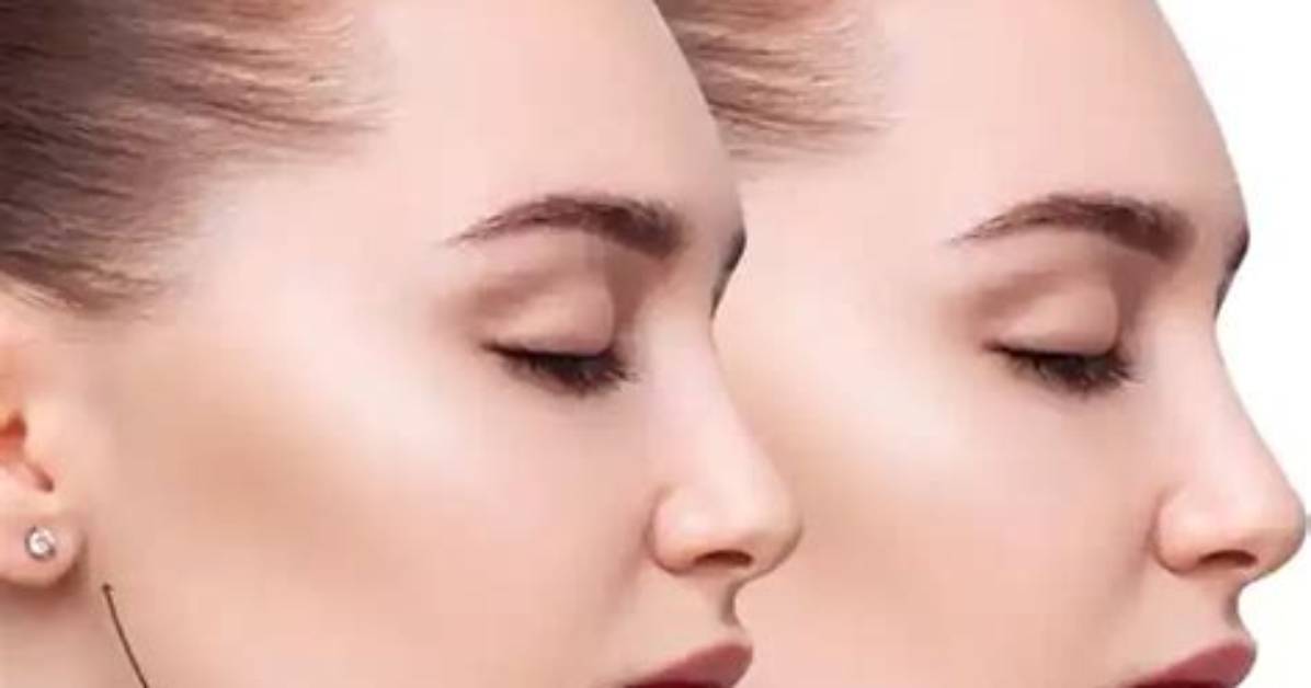 Does Kybella Work on Everyone?