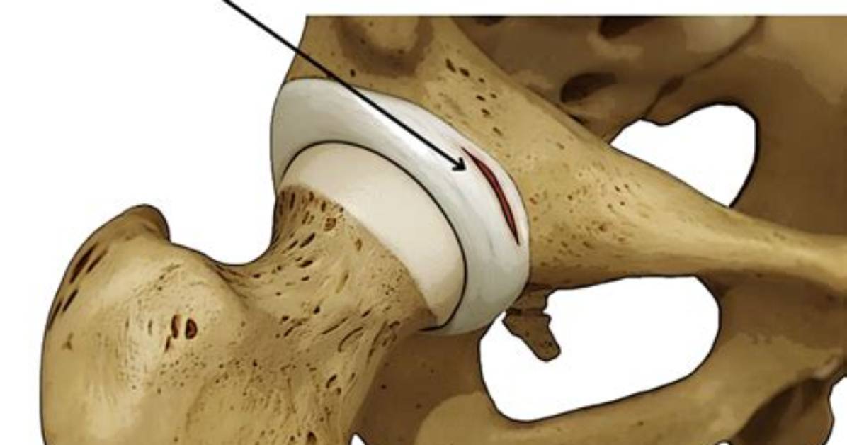 Does Labral Tear Lead to Hip Replacement?