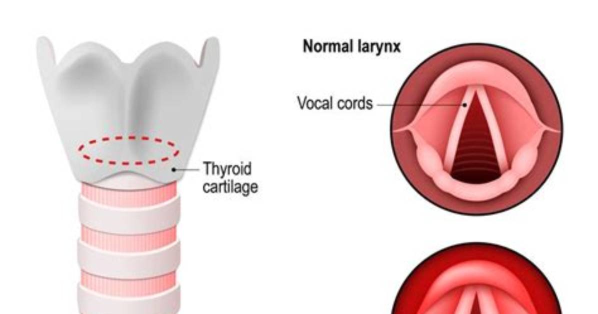Does Laryngitis Make You Feel Ill