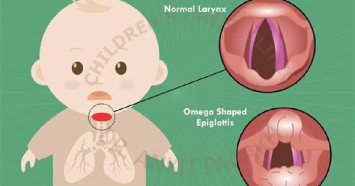 Does Laryngomalacia Affect Sleep?