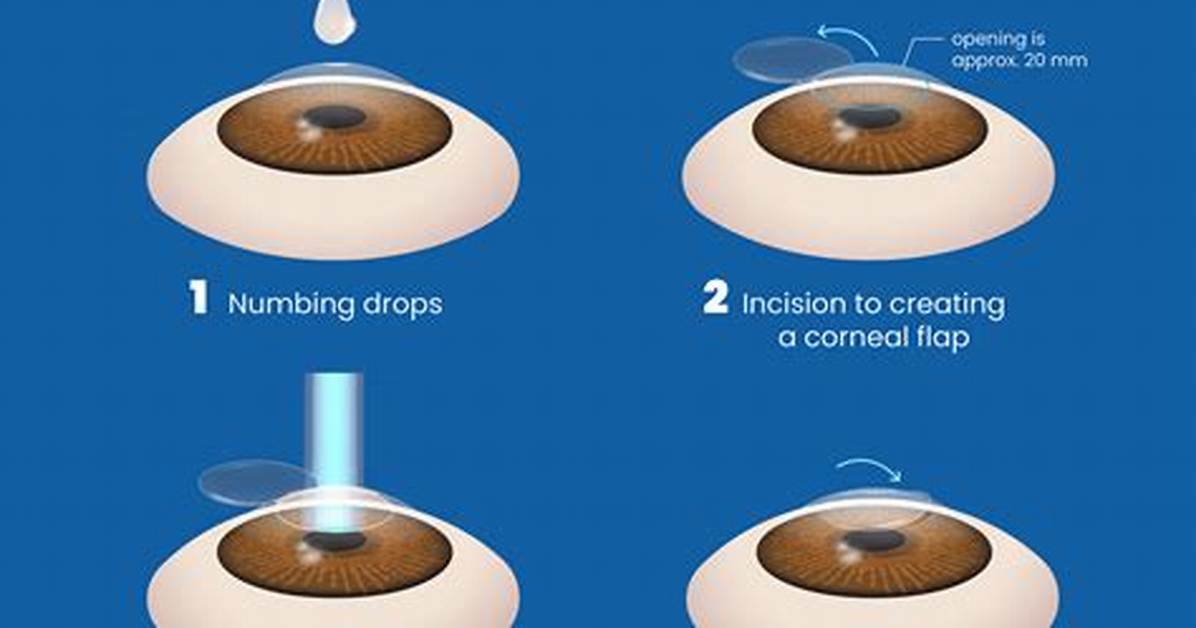 Does Lasik Fix Cross Eyes?