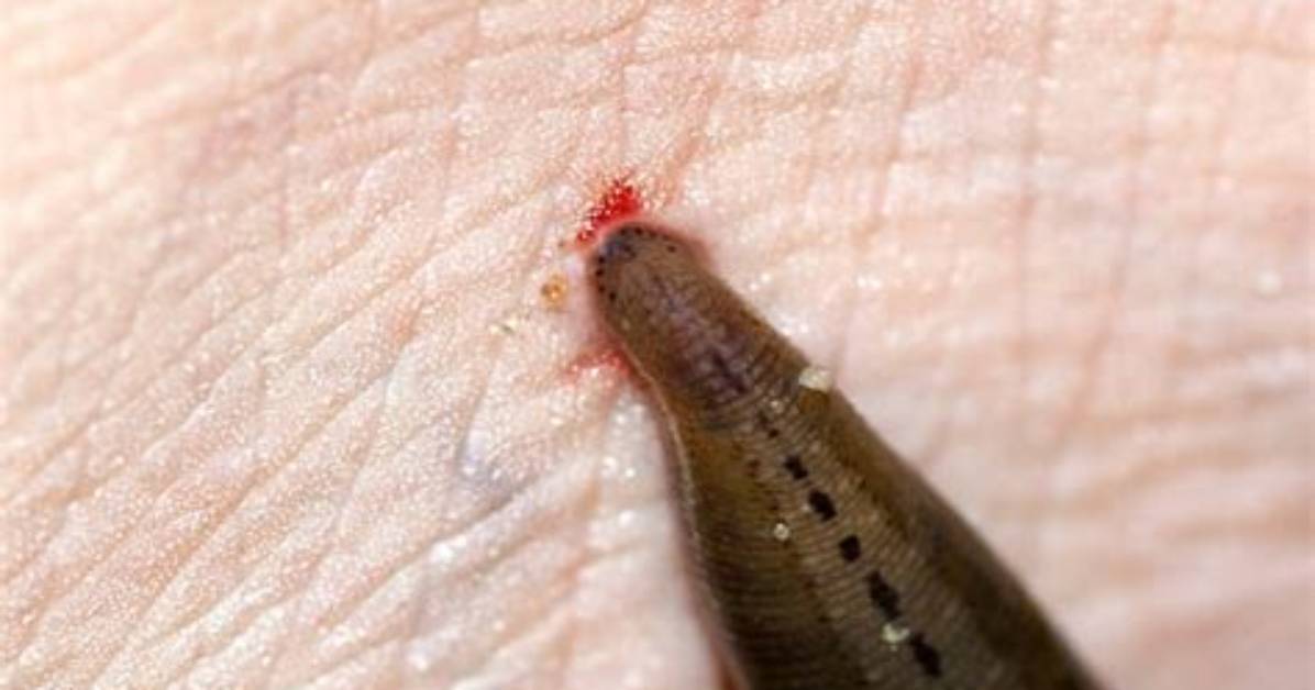 Does Leech Bite Hurt?