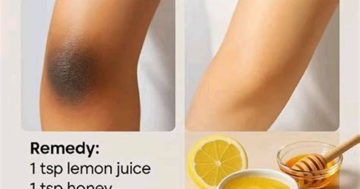 Does Lemon Lighten Elbows?