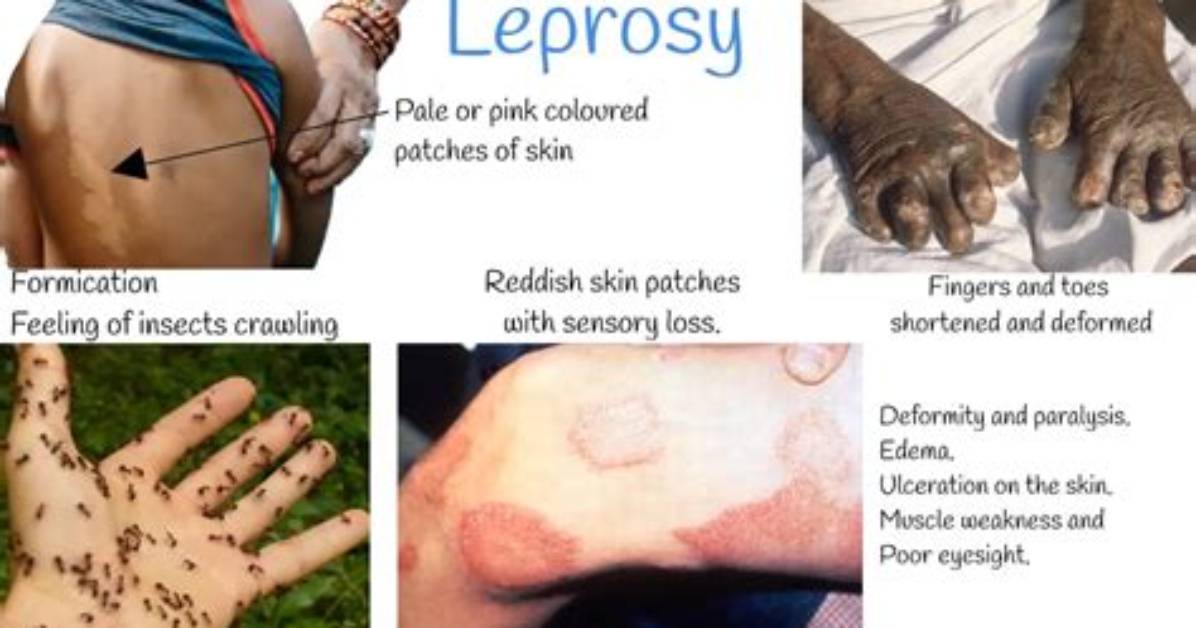 Does Leprosy Spread by Touch?