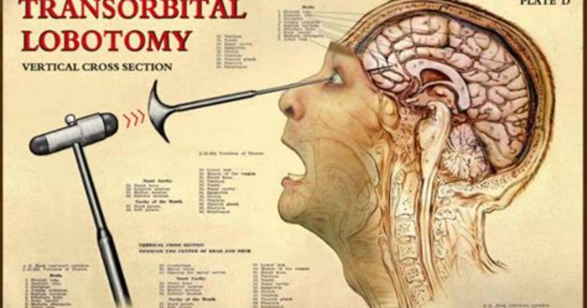 Does Lobotomy Actually Work?