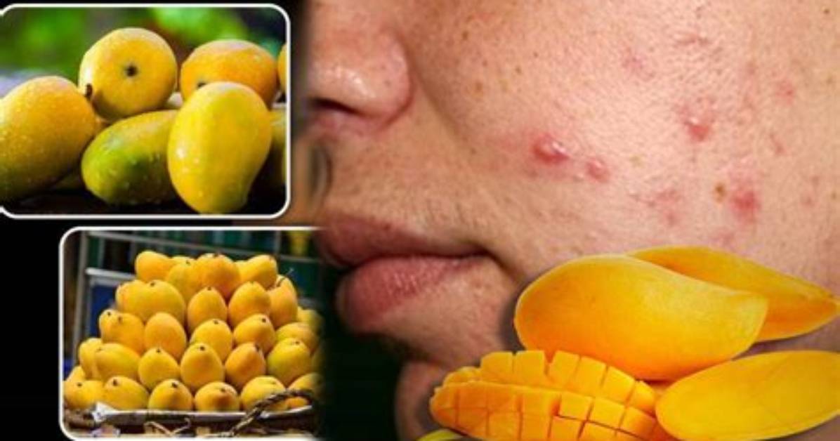 Does Mango Cause Acne?