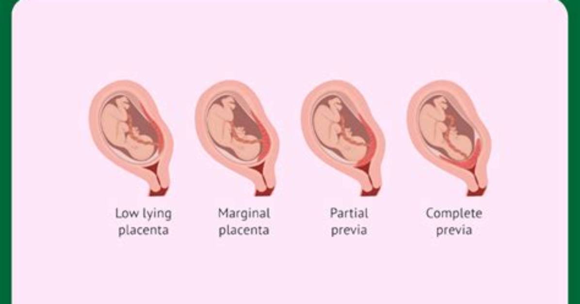 Does Marginal Placenta Previa Correct Itself?