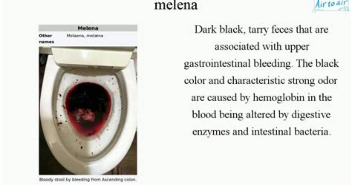 Does Melena Always Smell