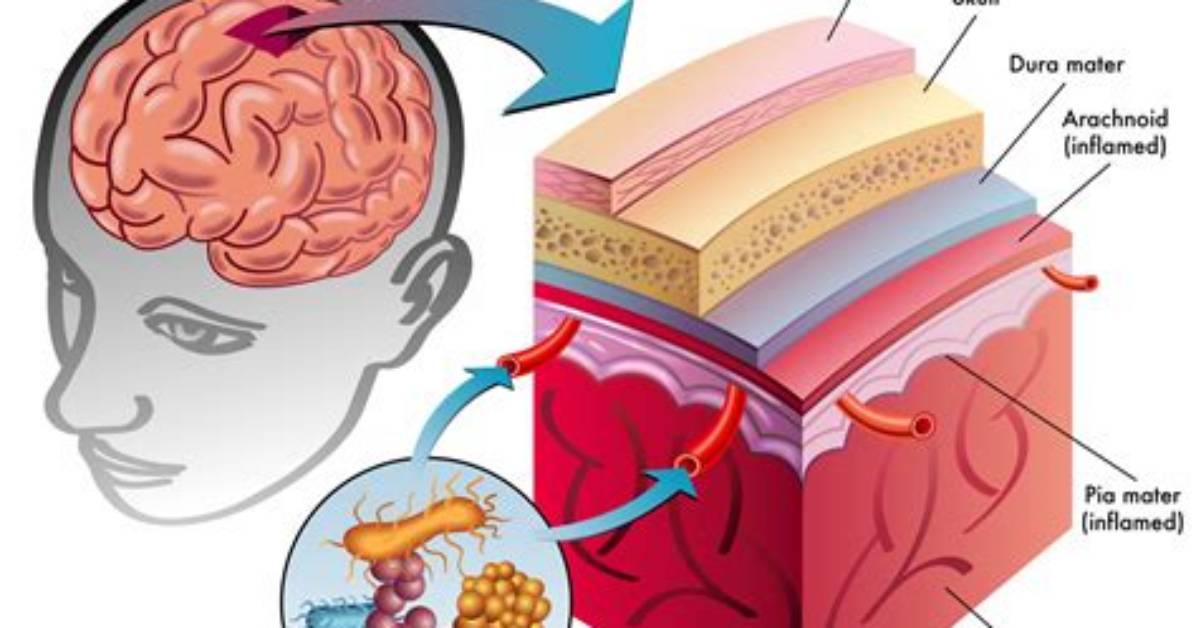 Does Meningococcal Cause Meningitis?