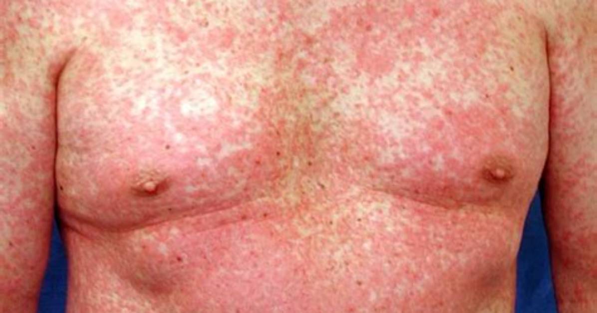 Does Morbilliform Rash Itch?