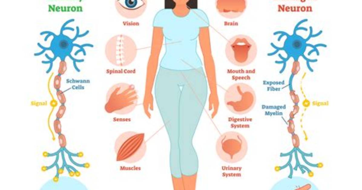 Does Ms Cause Clonus?