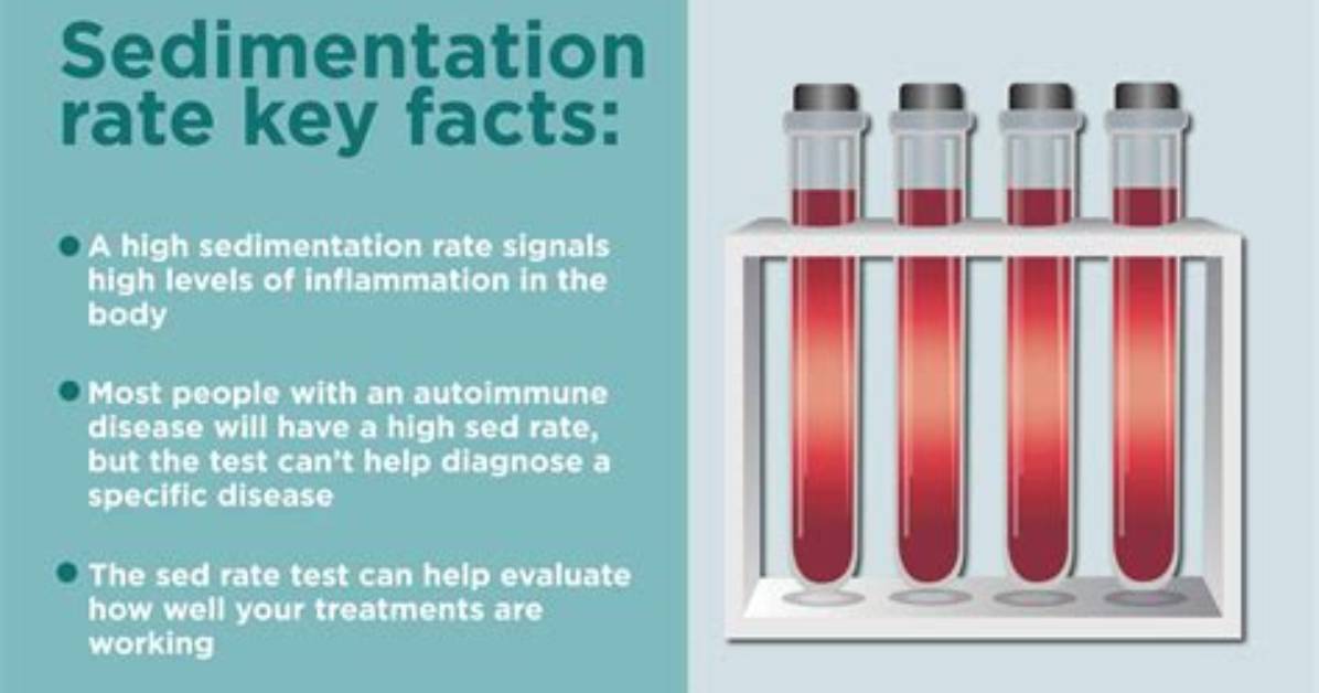 Does Ms Cause High Sedimentation Rate?