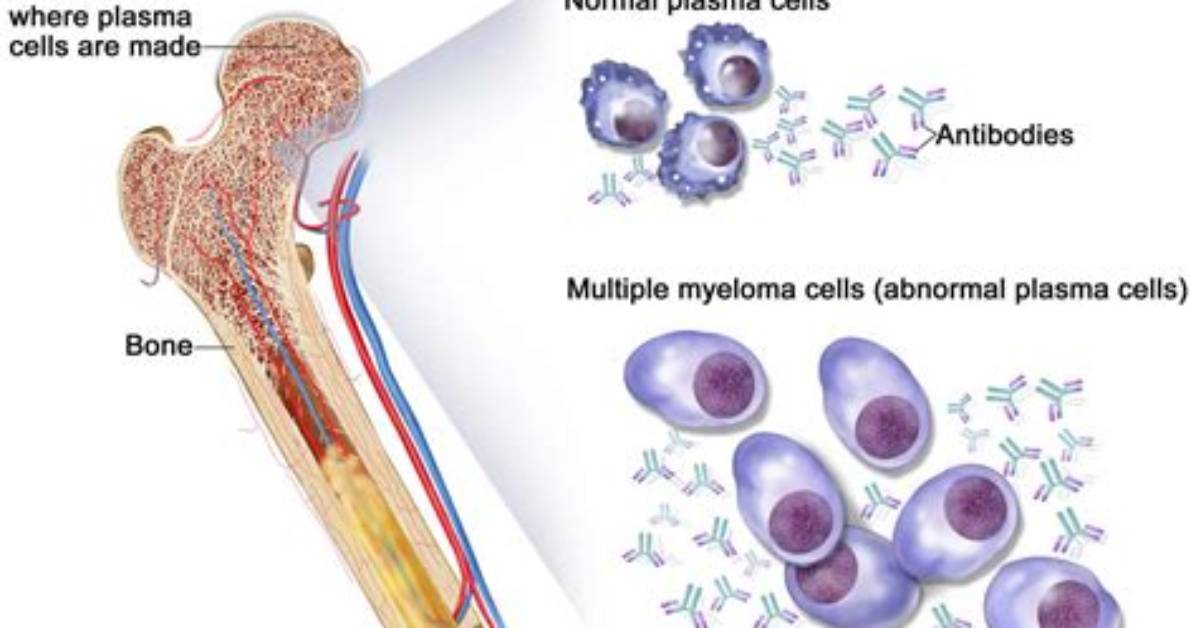 Does Multiple Myeloma Show up on Bone Scan
