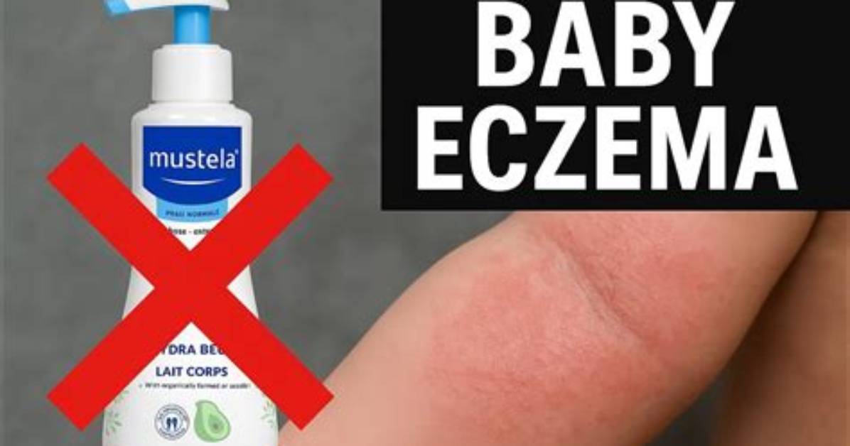 Does Mustela Work for Eczema?