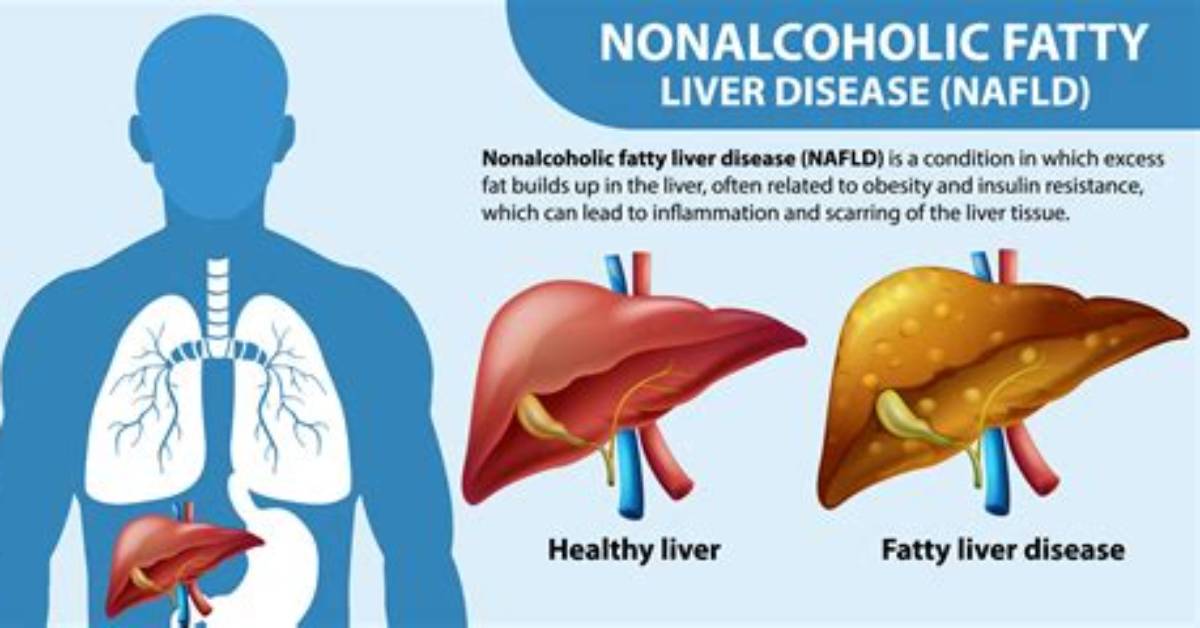 Does Nafld Cause Itching?