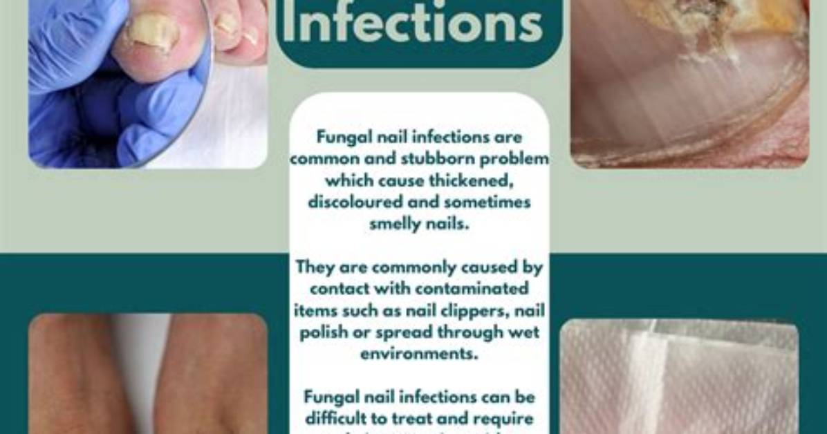 Does Nail Fungus Spread?