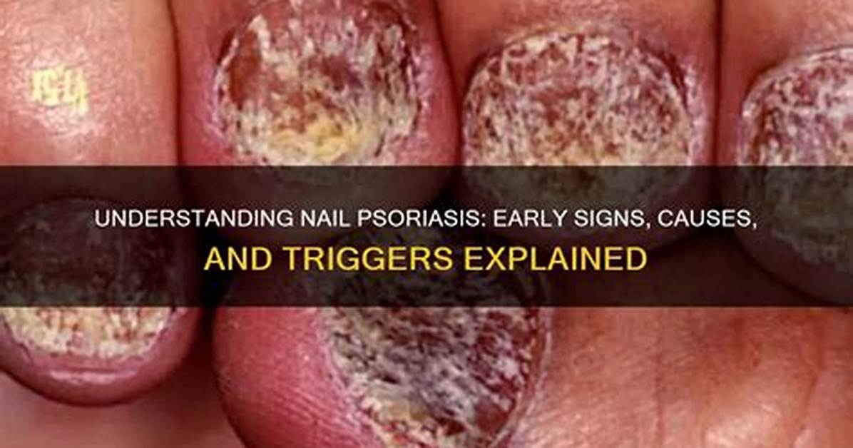 Does Nail Psoriasis Affect All Nails?