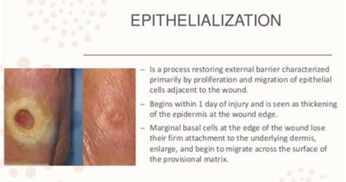 Does Newly Epithelialized Mean Healed?