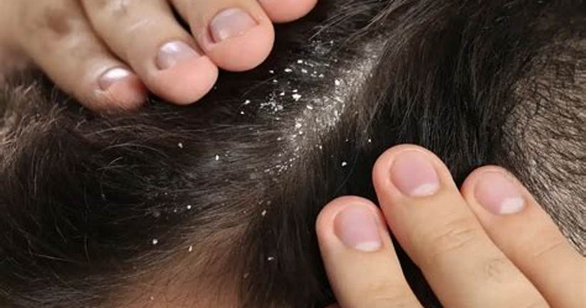 Does Not Shampooing Cause Dandruff?