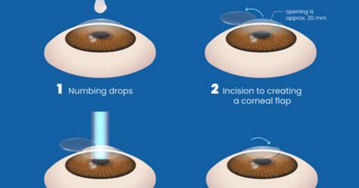 Does Number Come Back After Lasik?