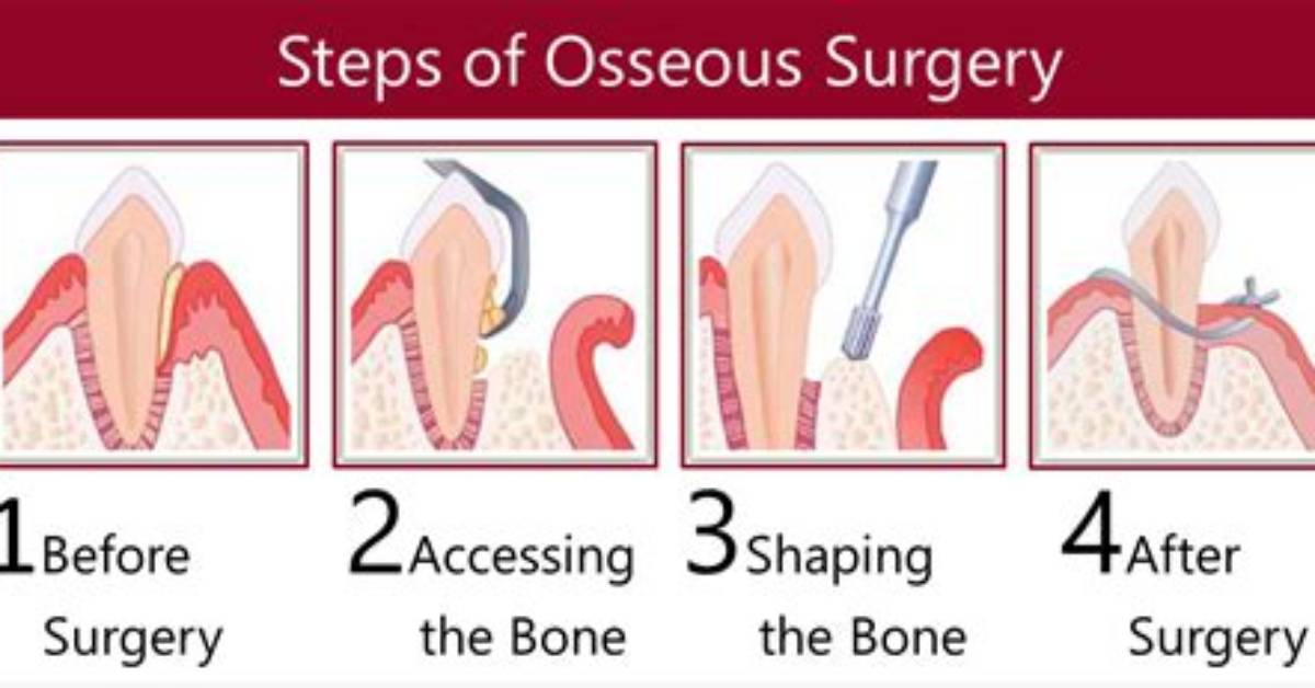 Does Osseous Surgery Work?