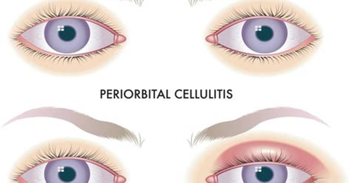 Does Periorbital Cellulitis Recur?