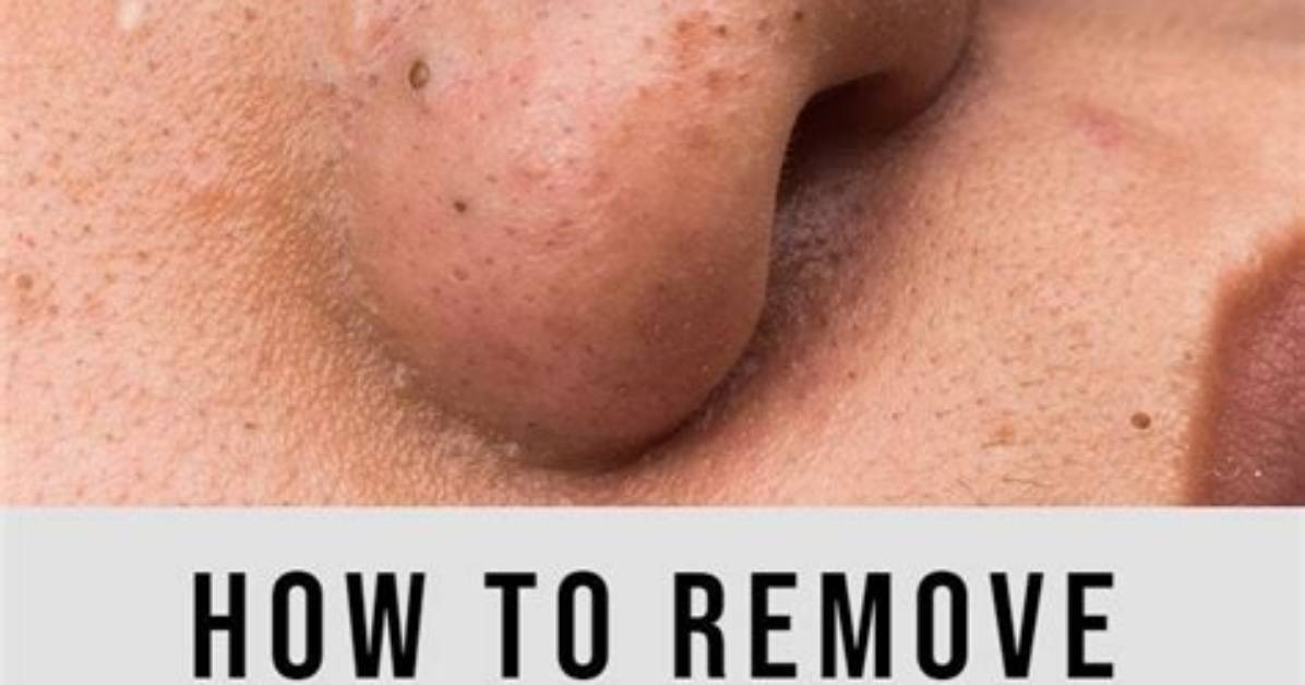 Does Peroxide Help with Blackheads?