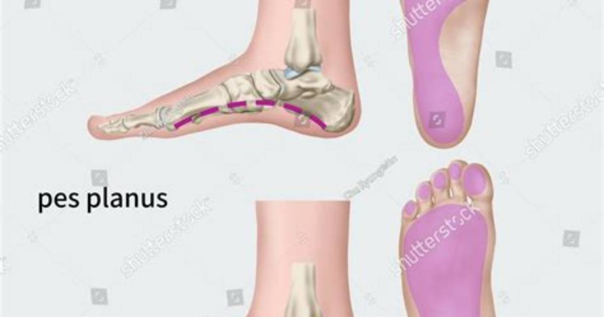 Does Pes Planus Go Away