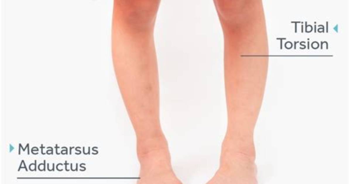 Does Pigeon Toed Correct Itself?