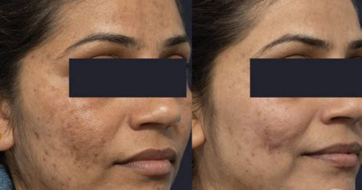Does Pigmentation from Laser Go Away?