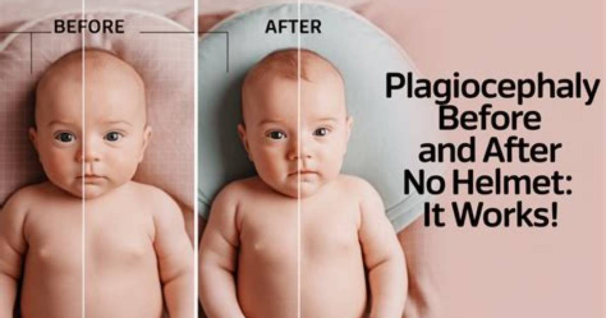Does Plagiocephaly Improve with Age?