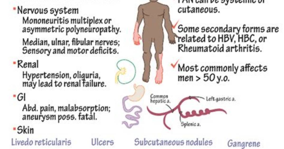 Does Polyarteritis Nodosa Go Away?