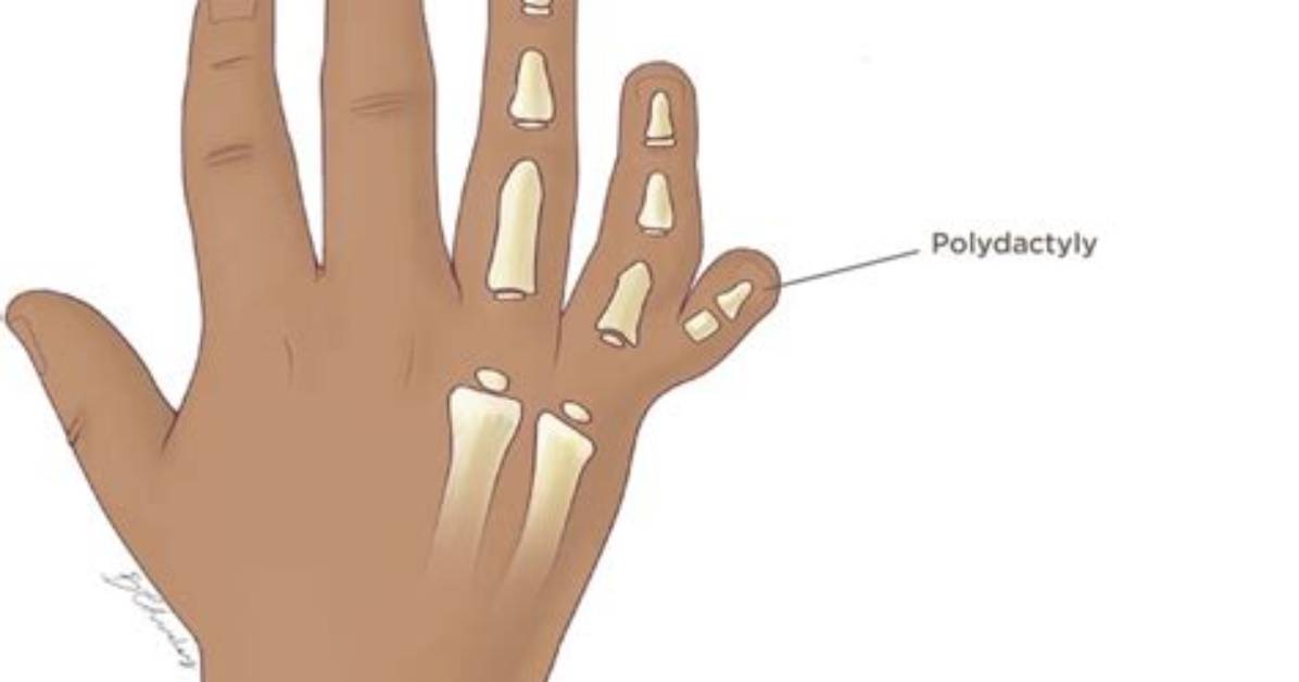 Does Polydactyly Cause Harm?