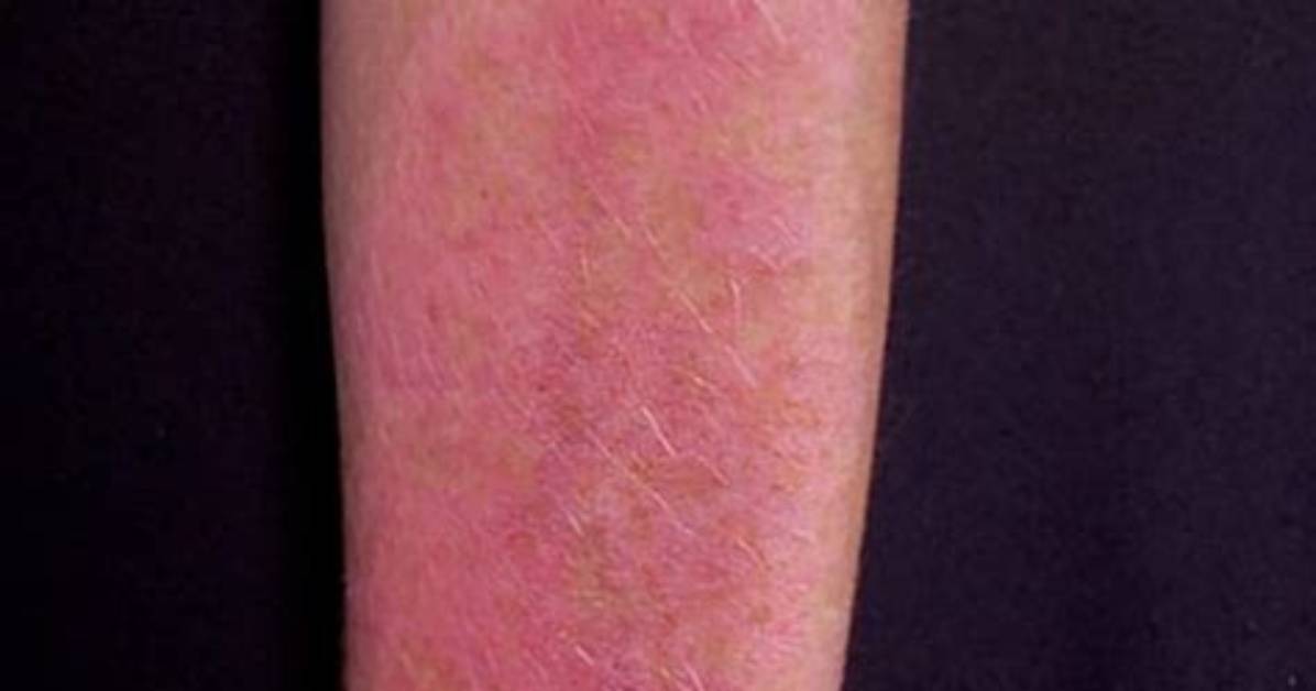 Does Polymorphous Light Eruption Spread?