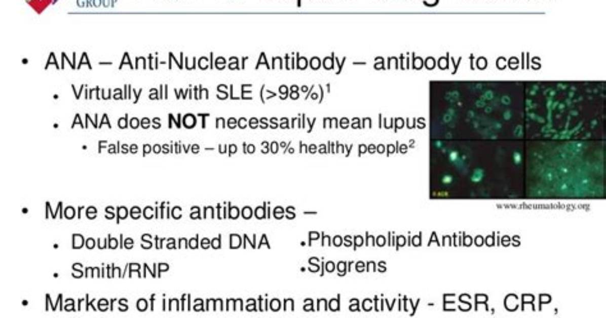 Does Positive Ana Mean Lupus