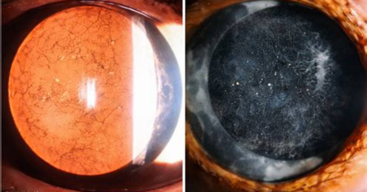 Does Posterior Capsule Opacification Get Worse?