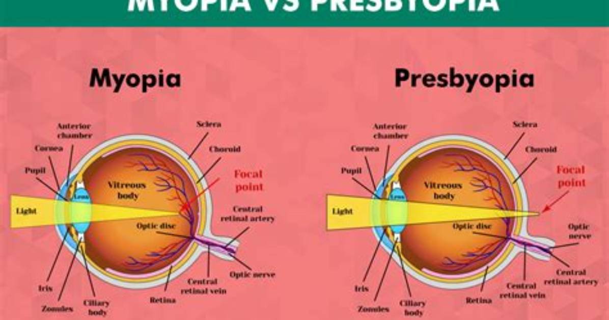 Does Presbyopia Improve Myopia?